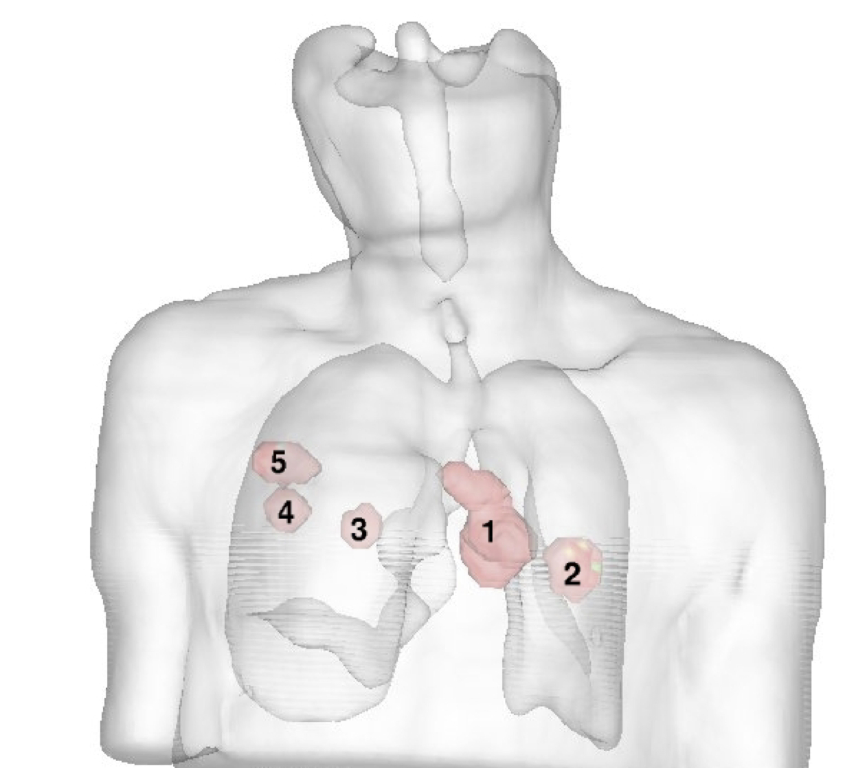 Multiple lung lesions rendering