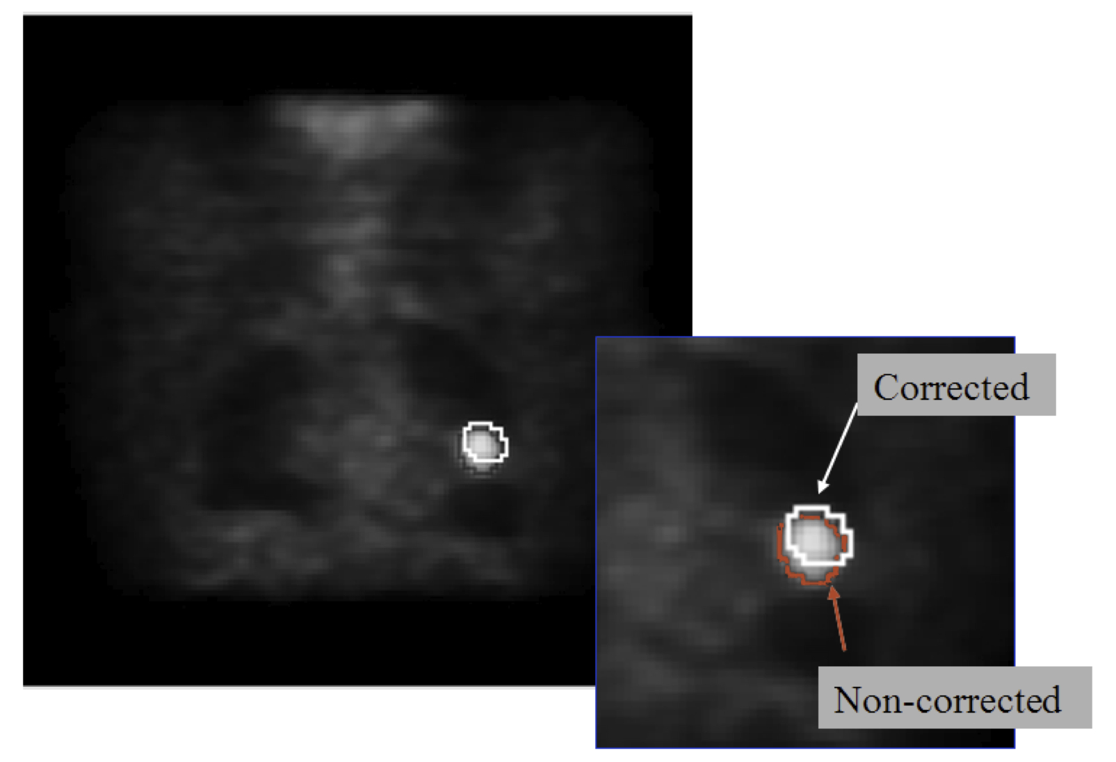 motion compensation results in correction of tumour boundaries